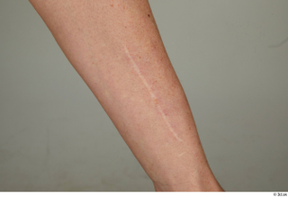  Steve Q forearm scar skin 0001.jpg